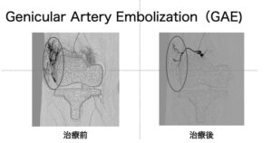 Genicular Artery Embolization (GAE)